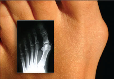 Bunion with X-ray