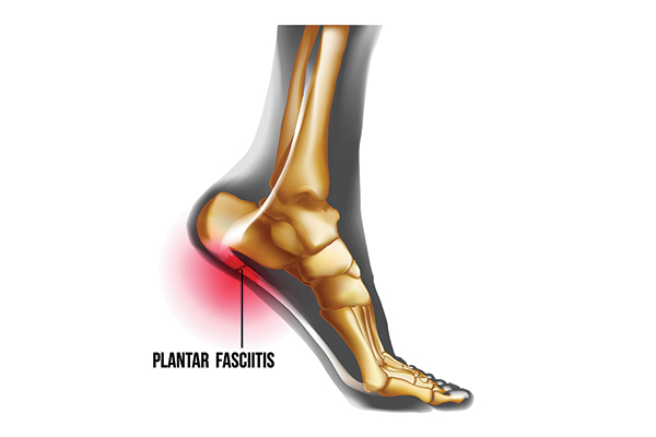 Plantar Fasciitis pain in the heel, see bones and where to support with Elite Feet Orthotics