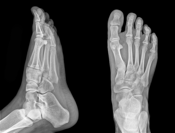 X-Ray of feet keep them healthy with elite feet USA orthotics by Tammy Harbison